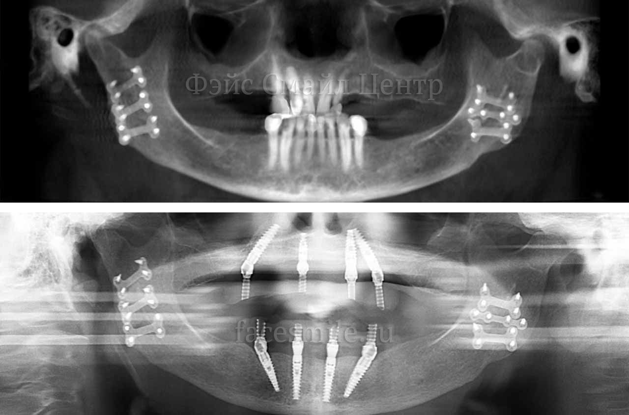 Пациент после операции по зубной имплантации все на четырех в клинике Фэйс Смайл центр в г. Москва