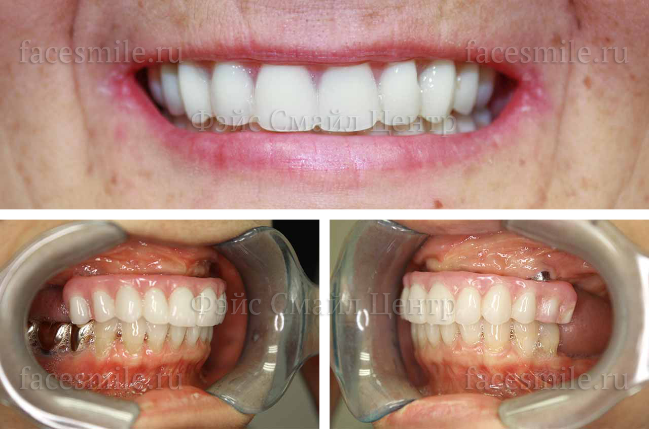 CT-Scan до и после имплантации зубов после травмы челюсть по методике все на четырех в клинике Фэйс Смайл центр