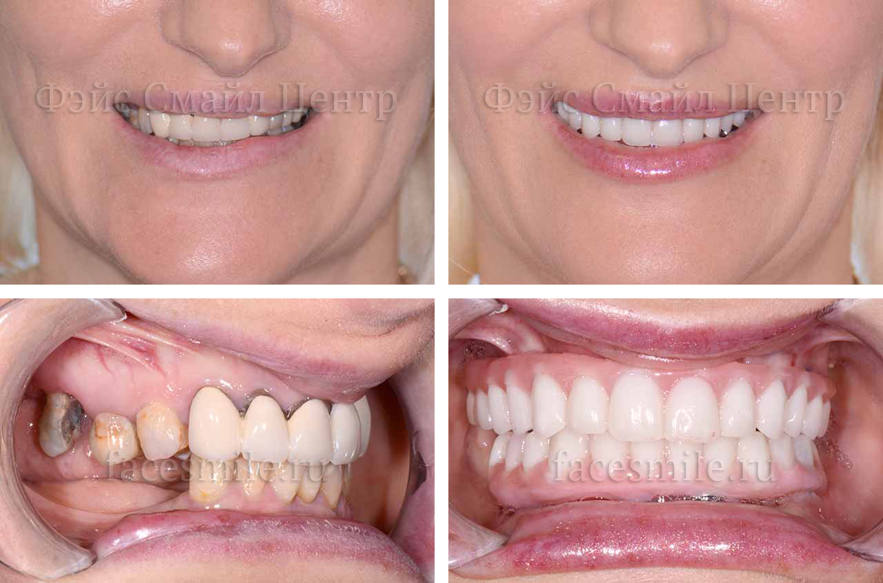 Пациентка до и после операции по зубной имплантации все на четырех в клинике Фэйс Смайл центр