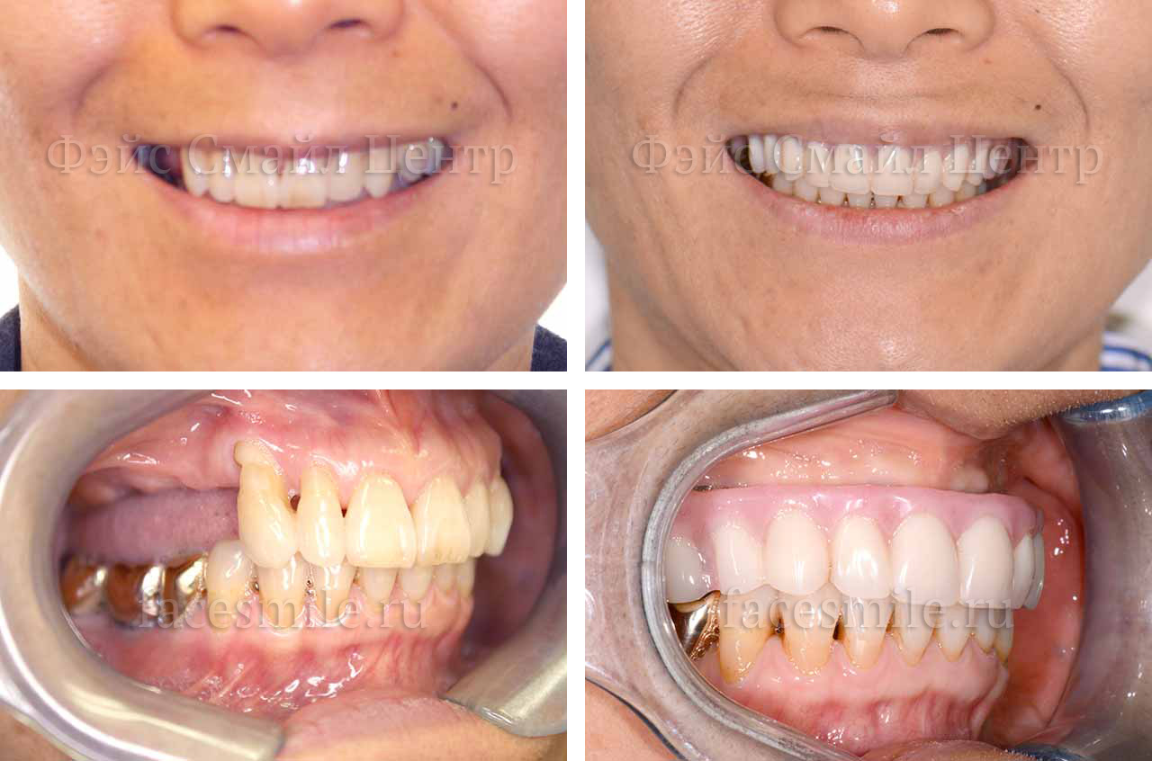 Пациент до и после операции по зубной имплантации верхней челюсти все на четырех в клинике Фэйс Смайл центр