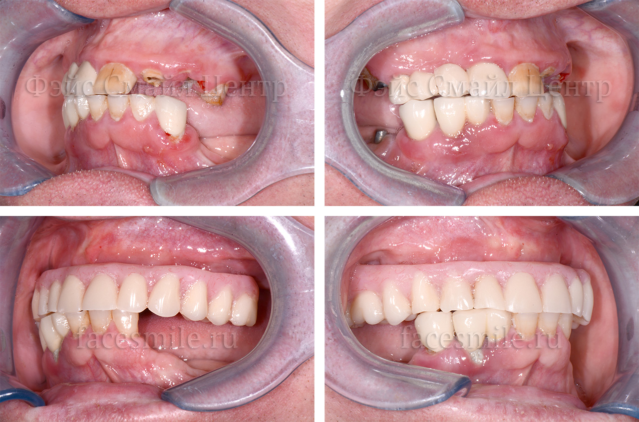 CT-Scan до и после имплантации зубов по методике все на четырех в клинике Фэйс Смайл центр в г.Москва