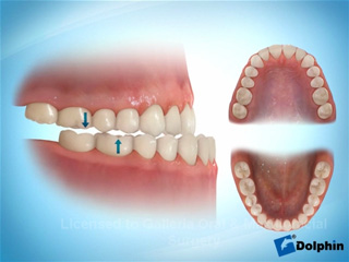 Соотношение зубов по III классу
