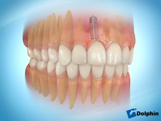 Имплант центрального зуба
