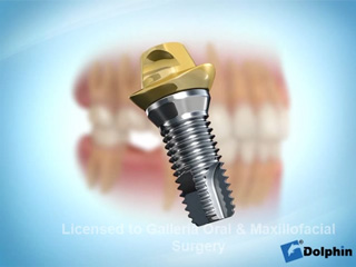 Установка имплантанта в области жевательных зубов