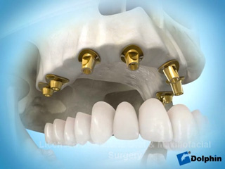 Полное восстановление зубного ряда